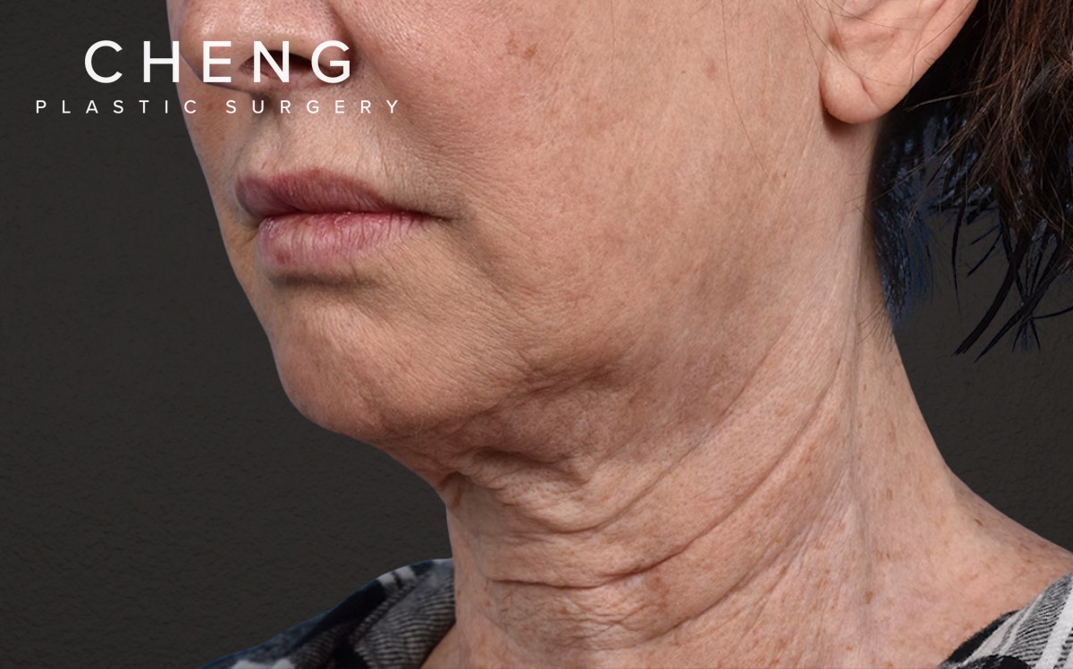 Neck Lift Before & After Gallery - Patient 238925 - Image 7