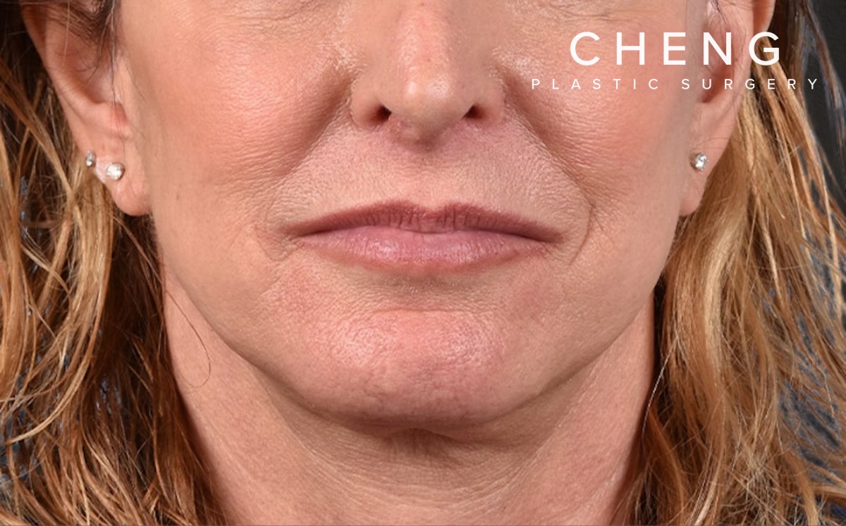 Neck Lift Before & After Gallery - Patient 522152 - Image 2