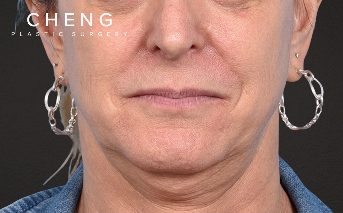 Neck Lift Before & After Gallery - Patient 522152 - Image 1