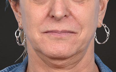 Neck Lift Before & After Gallery - Patient 522152 - Image 1