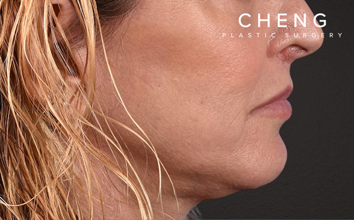 Neck Lift Before & After Gallery - Patient 522152 - Image 6