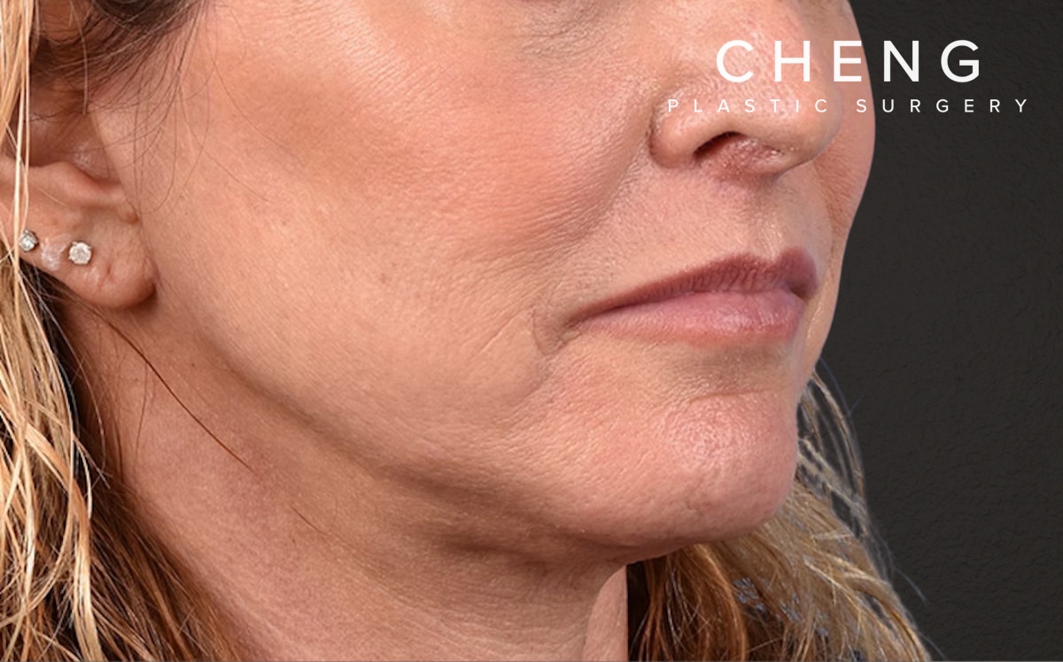 Neck Lift Before & After Gallery - Patient 522152 - Image 4