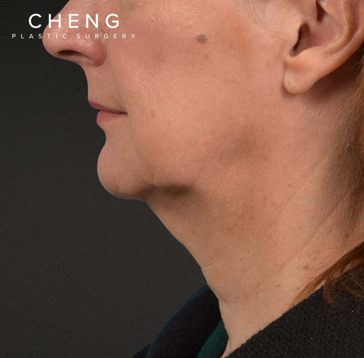 Neck Lift Before & After Gallery - Patient 204140 - Image 9