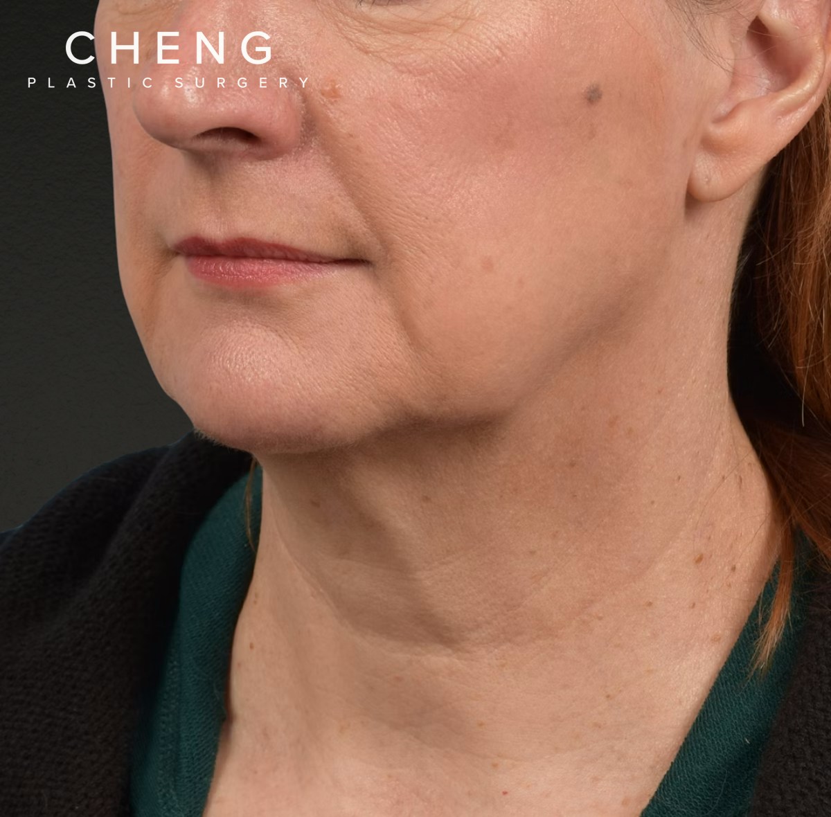 Neck Lift Before & After Gallery - Patient 204140 - Image 7