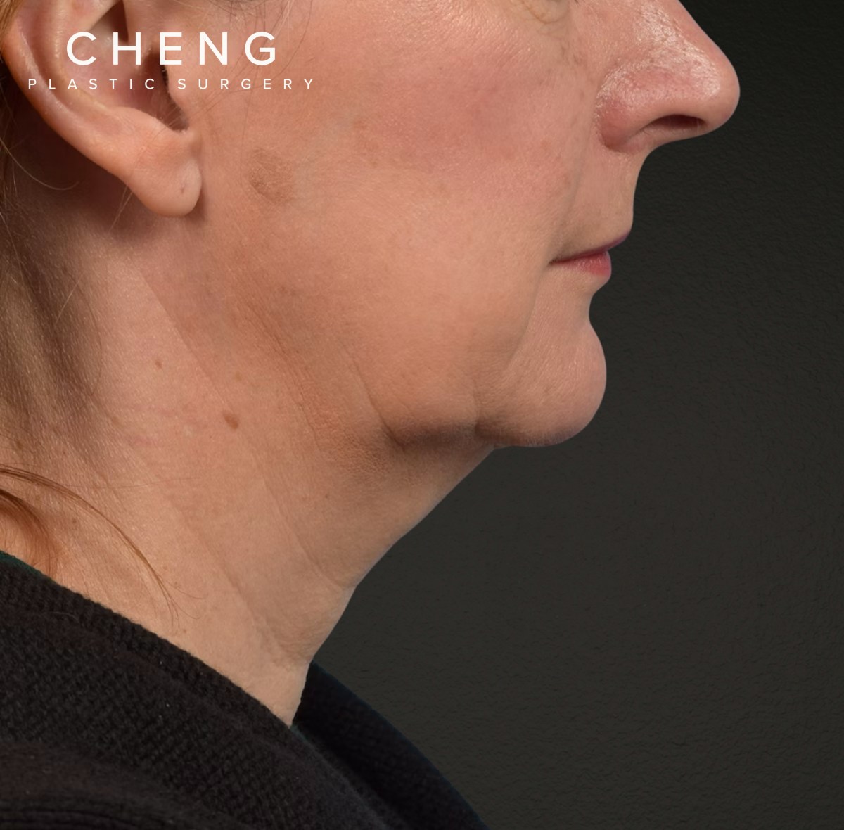Neck Lift Before & After Gallery - Patient 204140 - Image 5