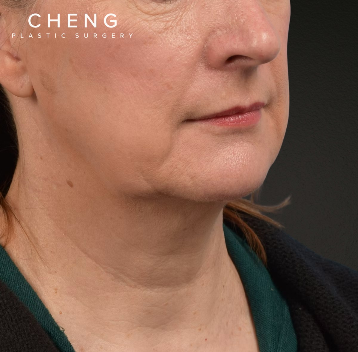 Neck Lift Before & After Gallery - Patient 204140 - Image 3