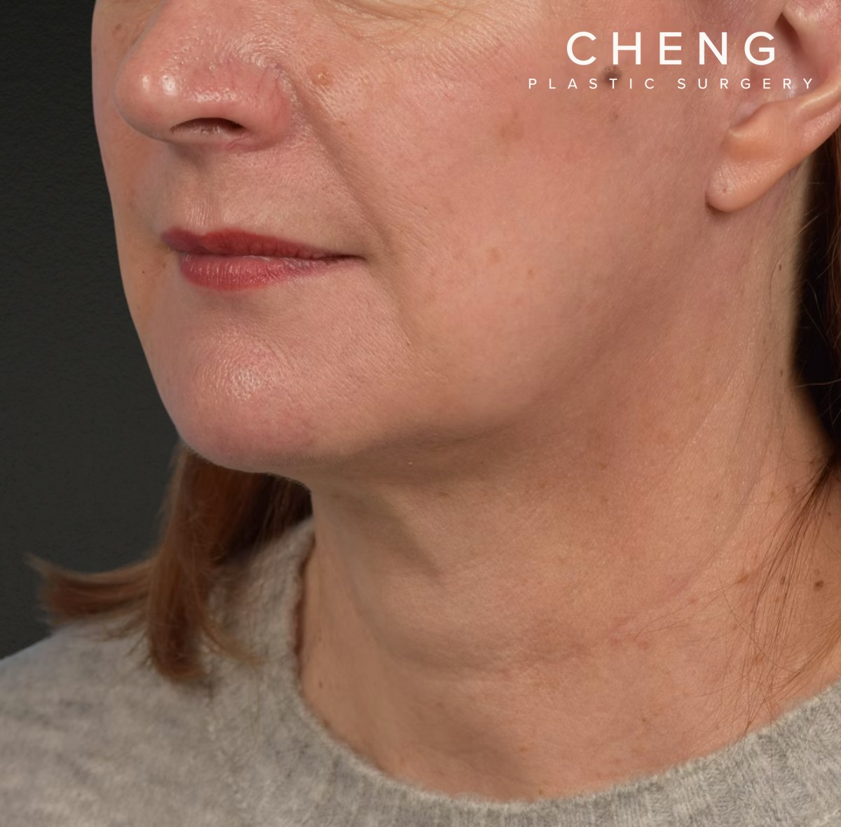 Neck Lift Before & After Gallery - Patient 204140 - Image 8