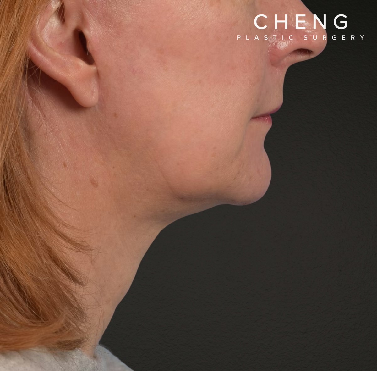 Neck Lift Before & After Gallery - Patient 204140 - Image 6