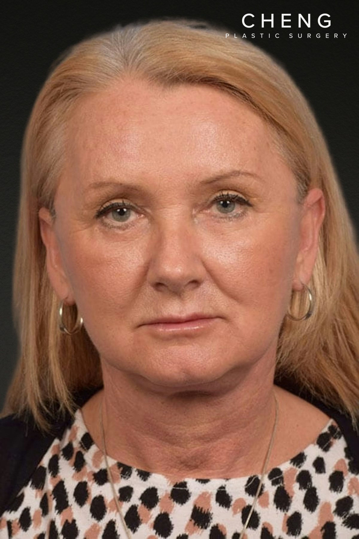 Neck Lift Before & After Gallery - Patient 207141 - Image 2