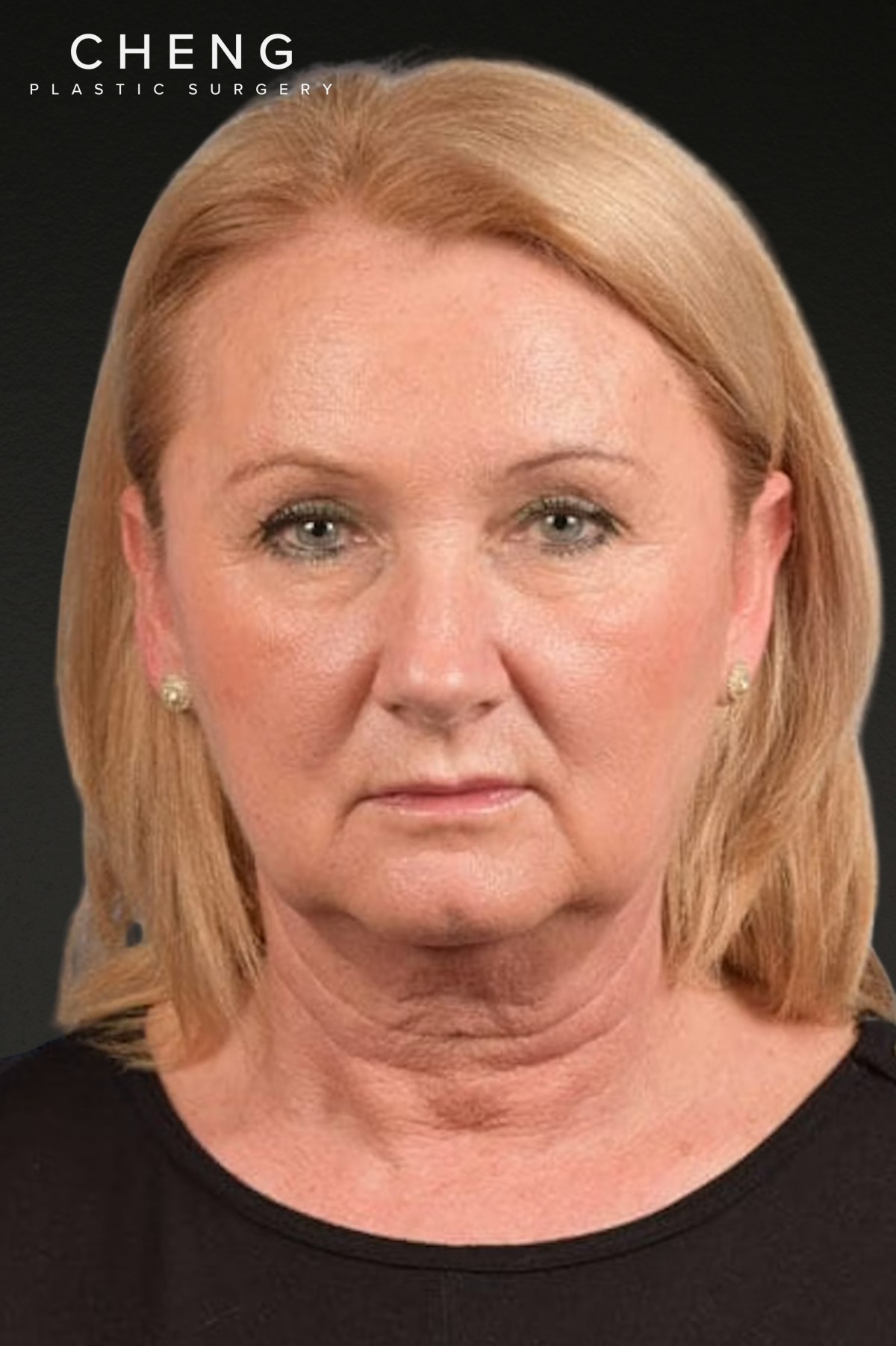 Neck Lift Before & After Gallery - Patient 207141 - Image 1