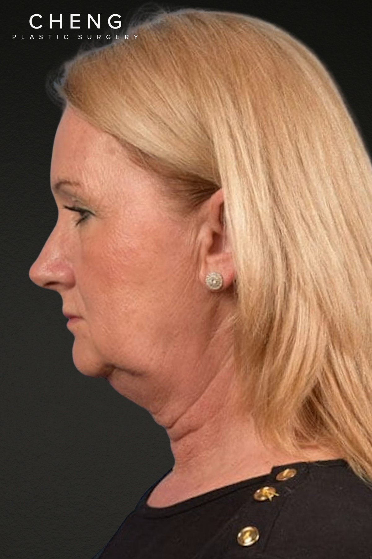 Neck Lift Before & After Gallery - Patient 207141 - Image 5