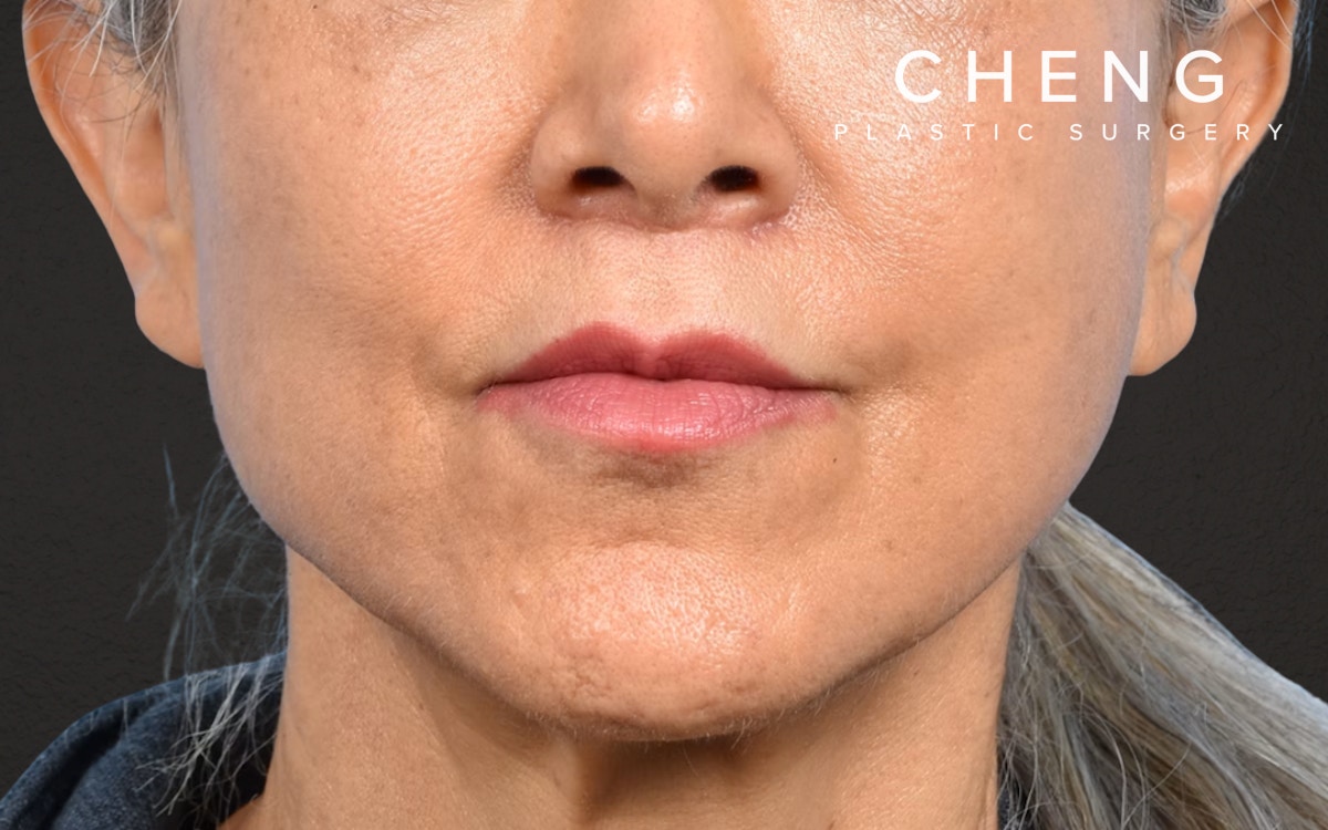 Lip Lift Before & After Gallery - Patient 376152 - Image 2