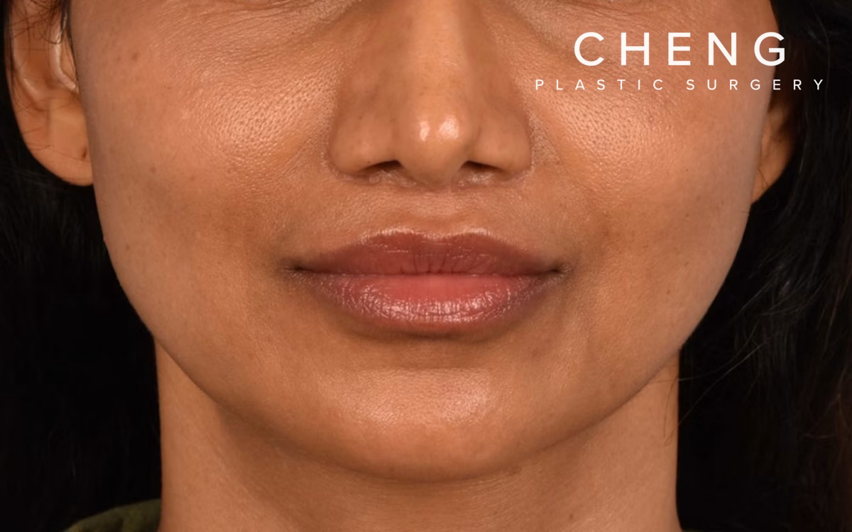 Lip Lift Before & After Gallery - Patient 369454 - Image 2