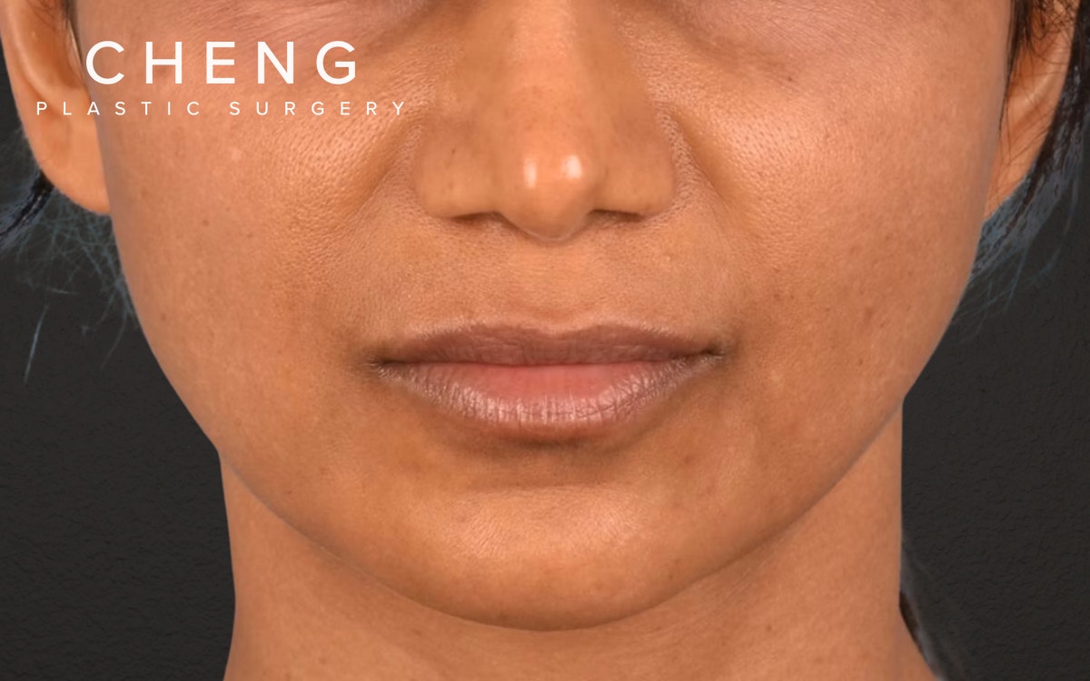 Lip Lift Before & After Gallery - Patient 369454 - Image 1