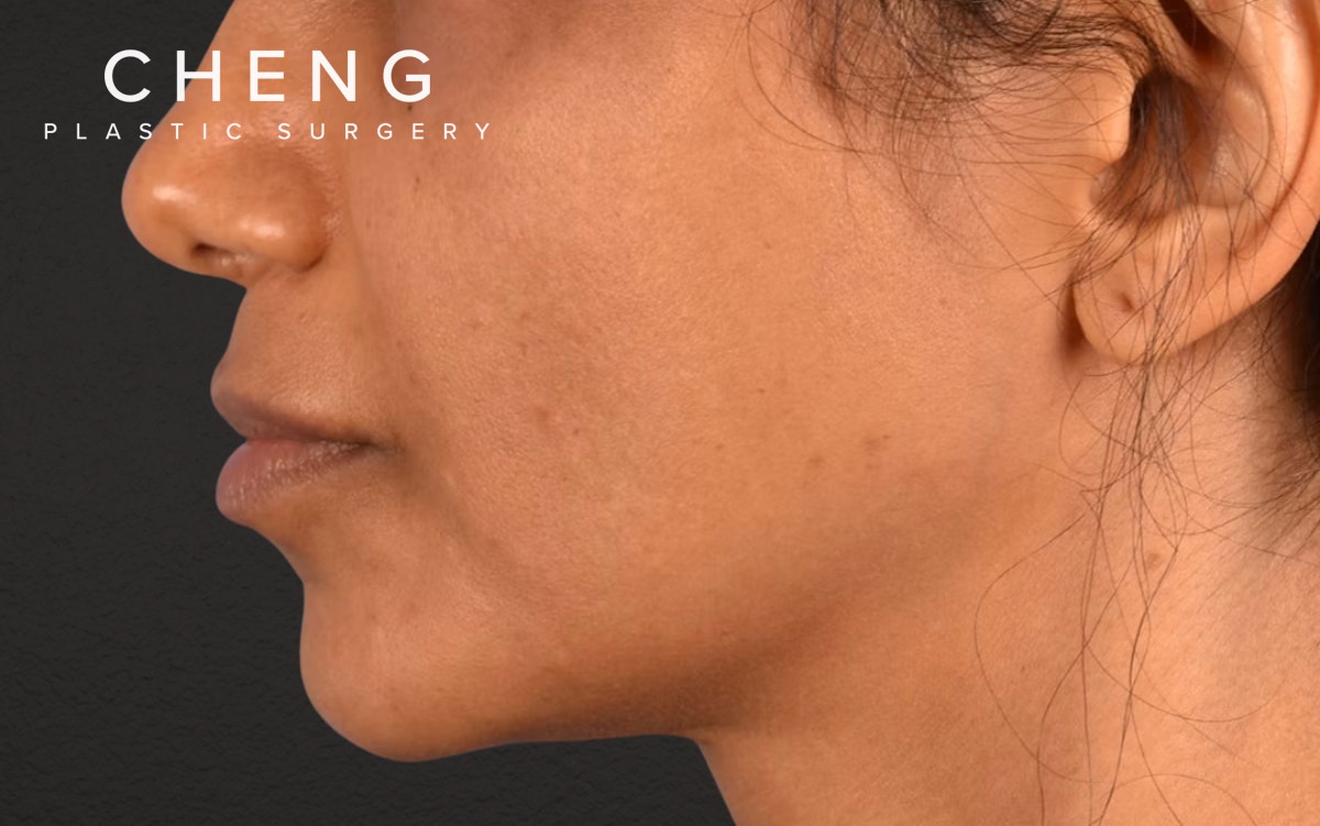 Lip Lift Before & After Gallery - Patient 369454 - Image 5