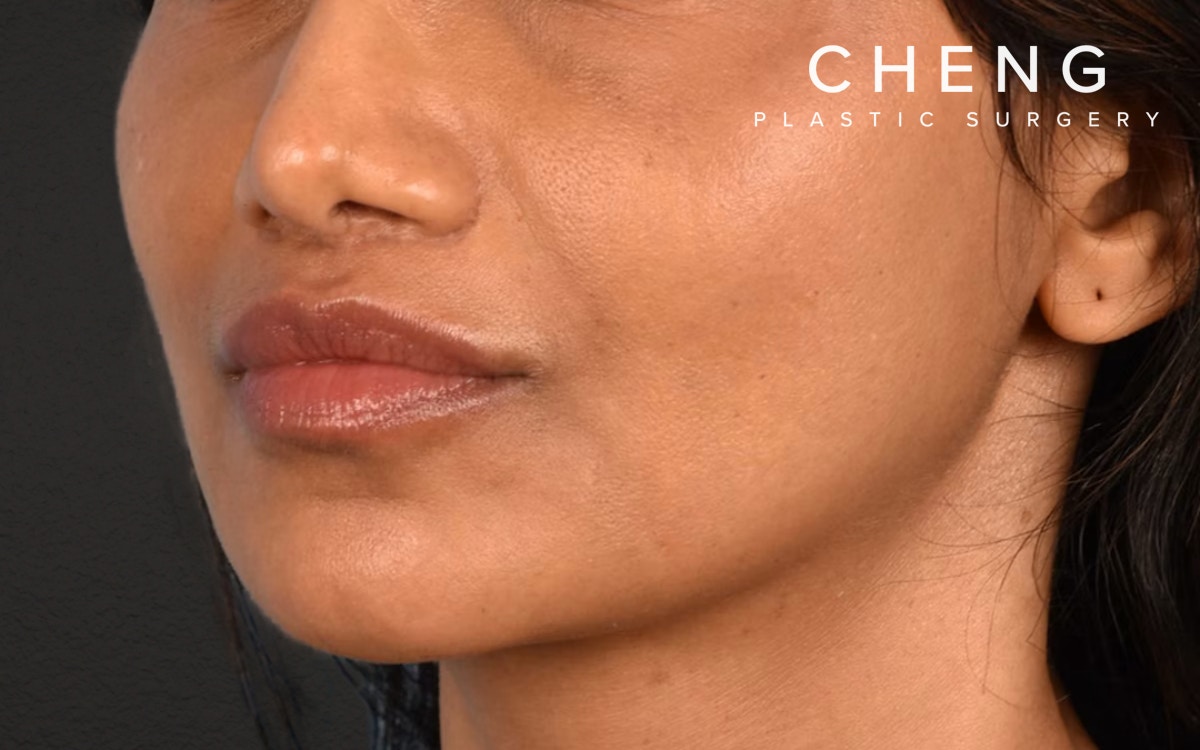 Lip Lift Before & After Gallery - Patient 369454 - Image 4