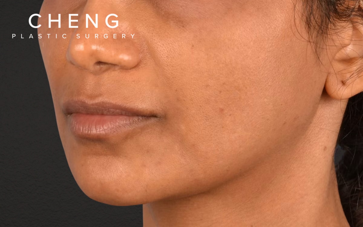 Lip Lift Before & After Gallery - Patient 369454 - Image 3