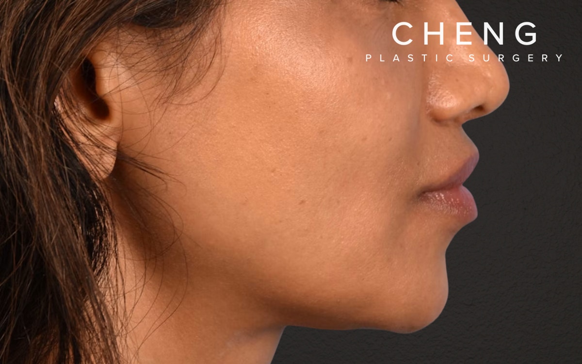 Lip Lift Before & After Gallery - Patient 369454 - Image 8