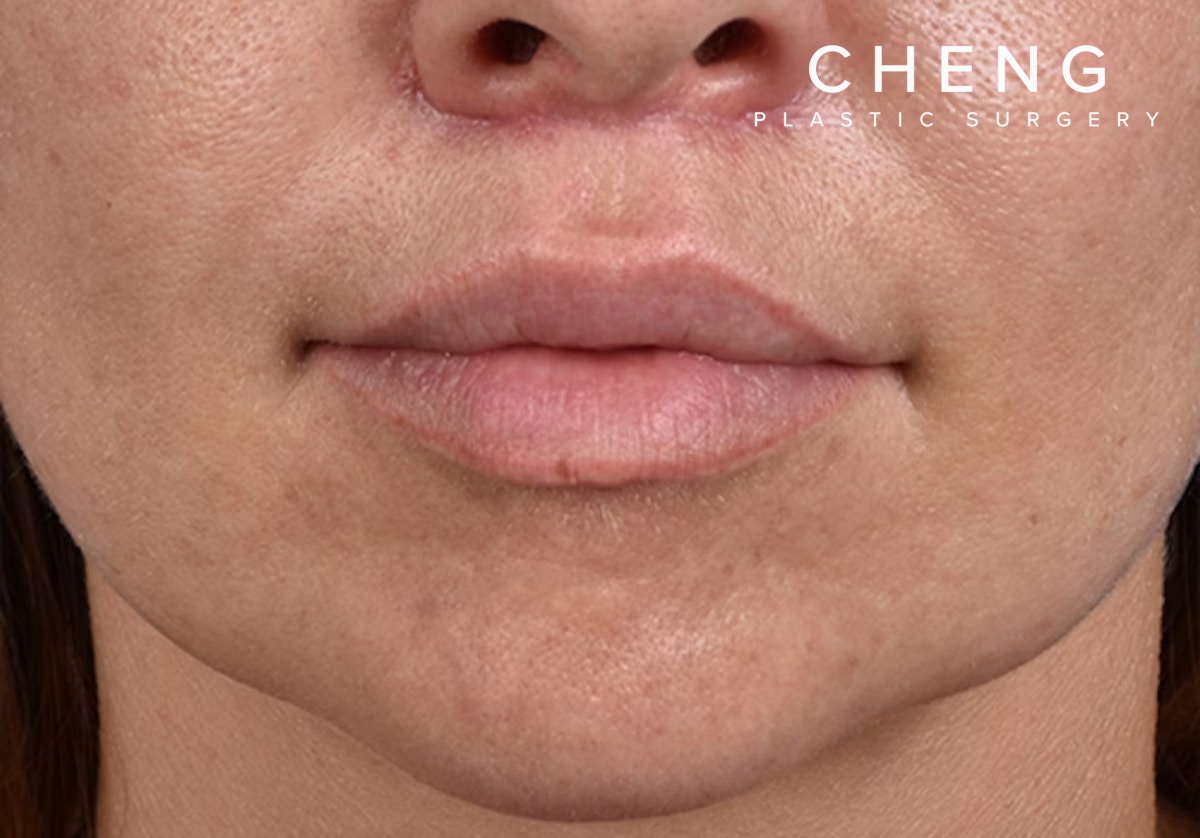 Lip Lift Before & After Gallery - Patient 797589 - Image 2