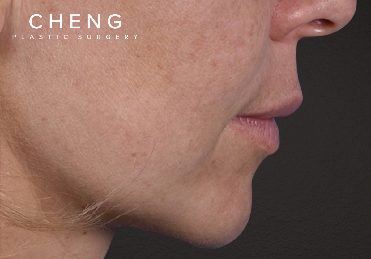 Lip Lift Before & After Gallery - Patient 797589 - Image 5