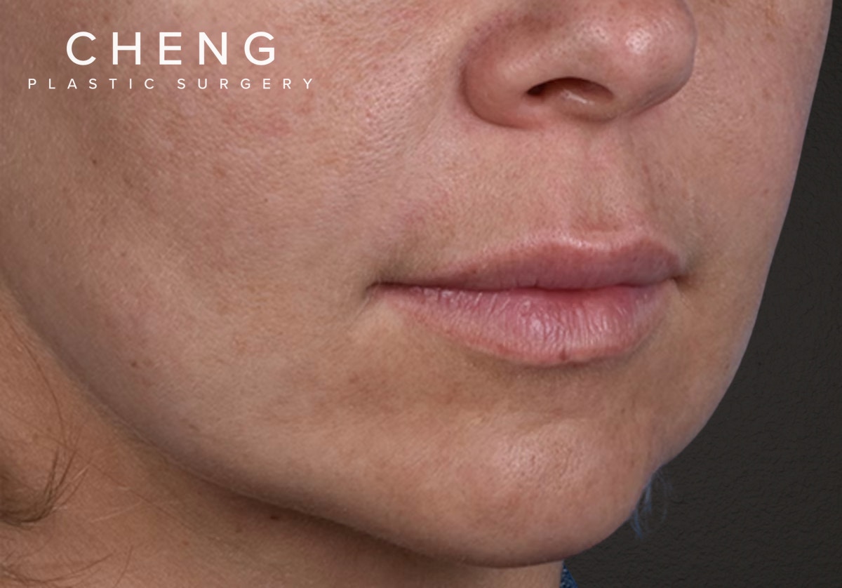 Lip Lift Before & After Gallery - Patient 797589 - Image 3