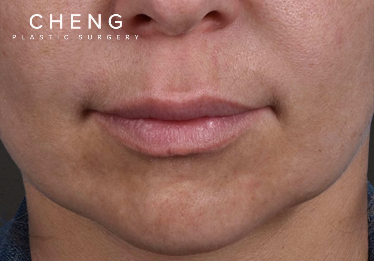 Lip Lift Before & After Gallery - Patient 797589 - Image 1