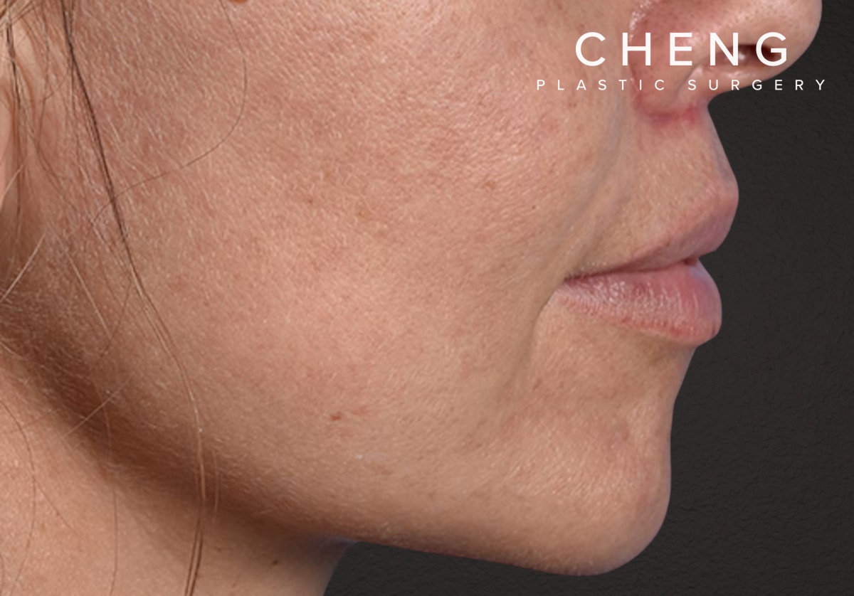 Lip Lift Before & After Gallery - Patient 797589 - Image 6