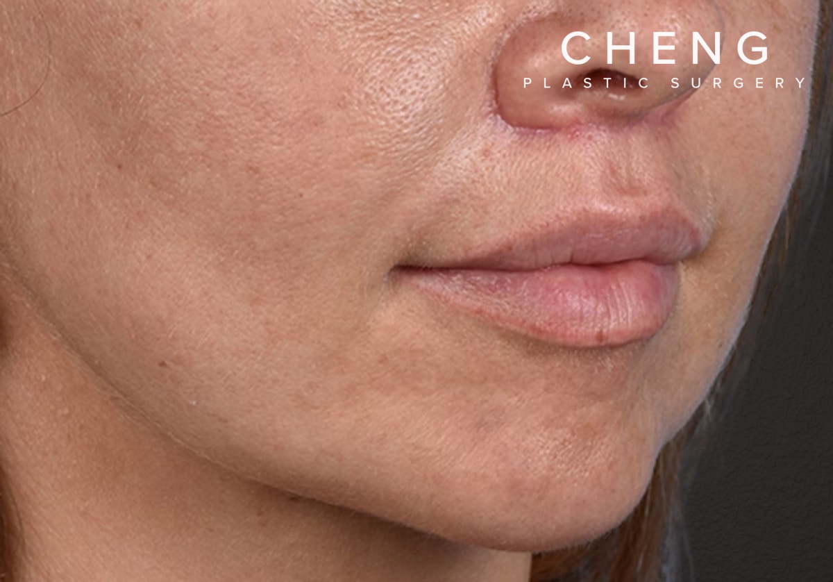 Lip Lift Before & After Gallery - Patient 797589 - Image 4