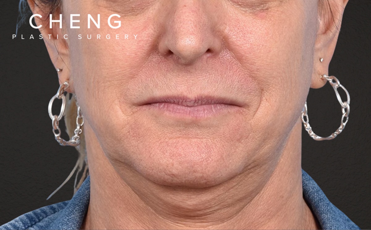 Lip Lift Before & After Gallery - Patient 135816 - Image 1