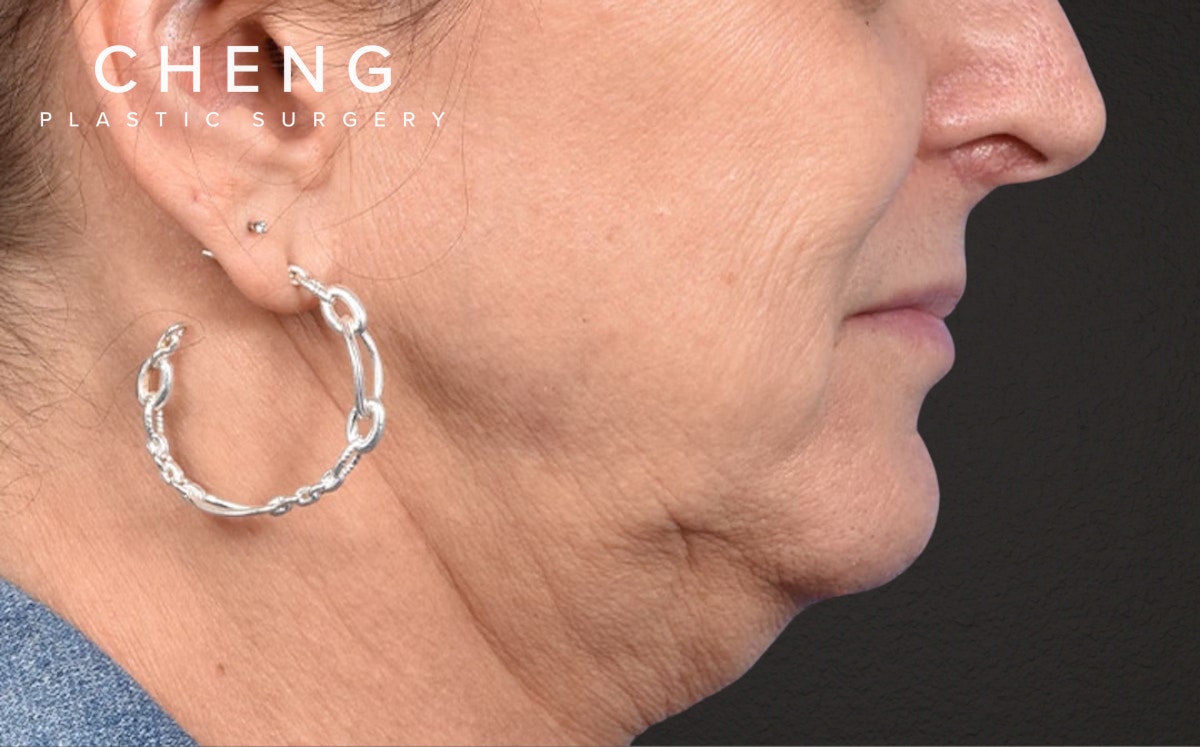 Lip Lift Before & After Gallery - Patient 135816 - Image 5