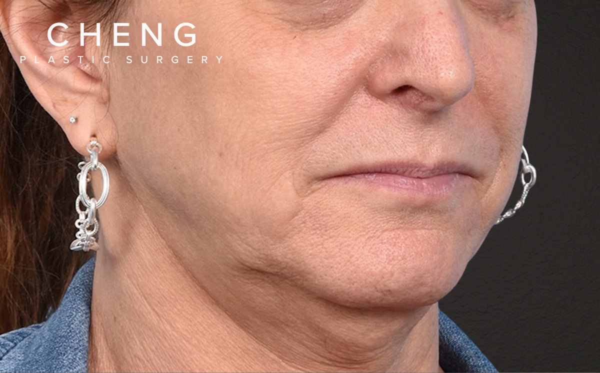 Lip Lift Before & After Gallery - Patient 135816 - Image 3