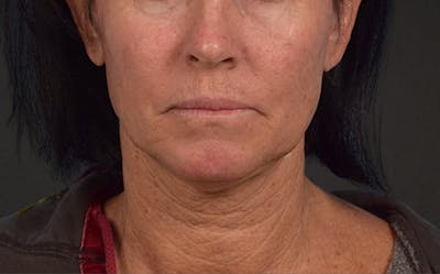 Lip Lift Before & After Gallery - Patient 587833 - Image 1