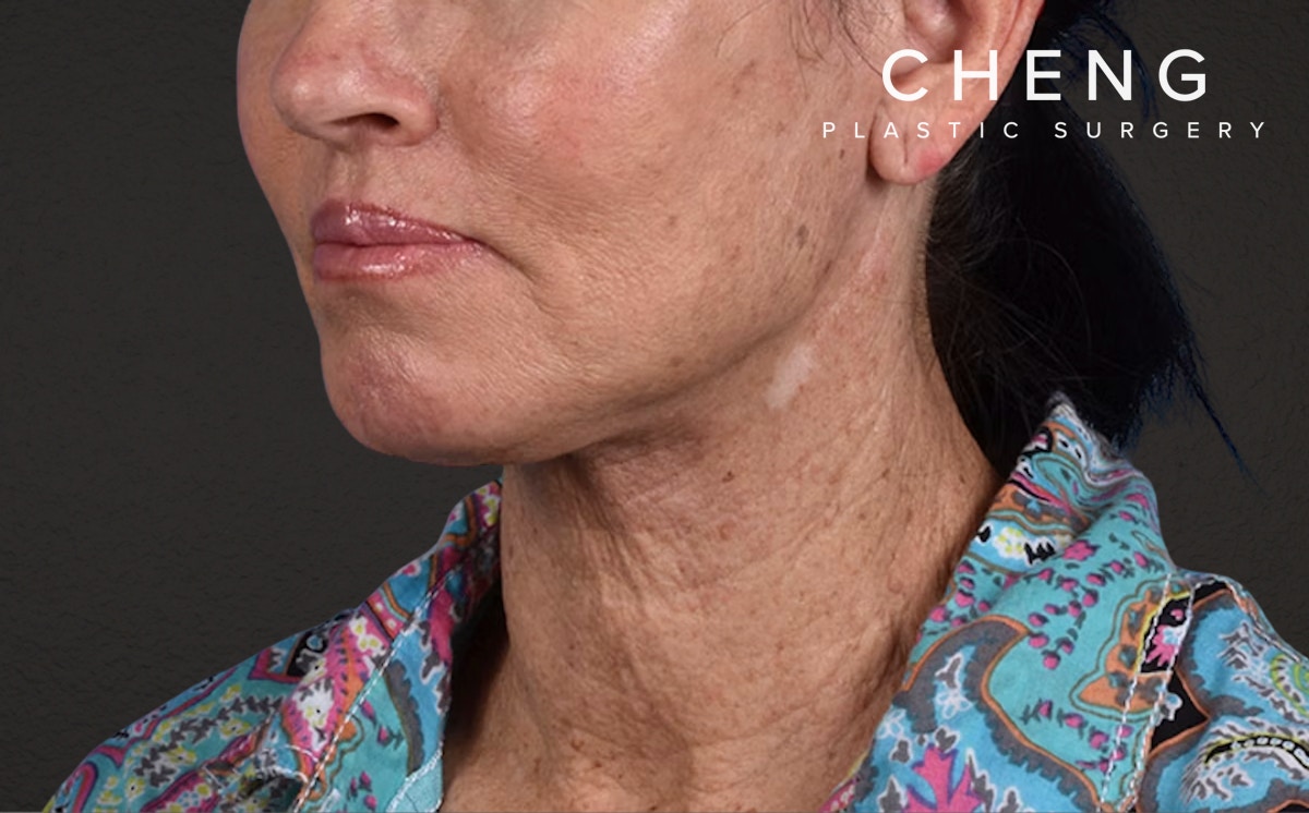 Lip Lift Before & After Gallery - Patient 587833 - Image 4