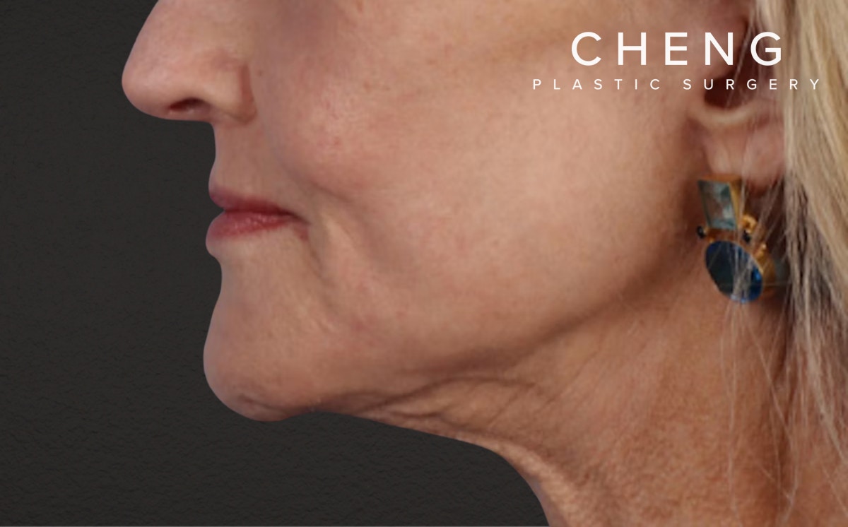 Lip Lift Before & After Gallery - Patient 340858 - Image 2