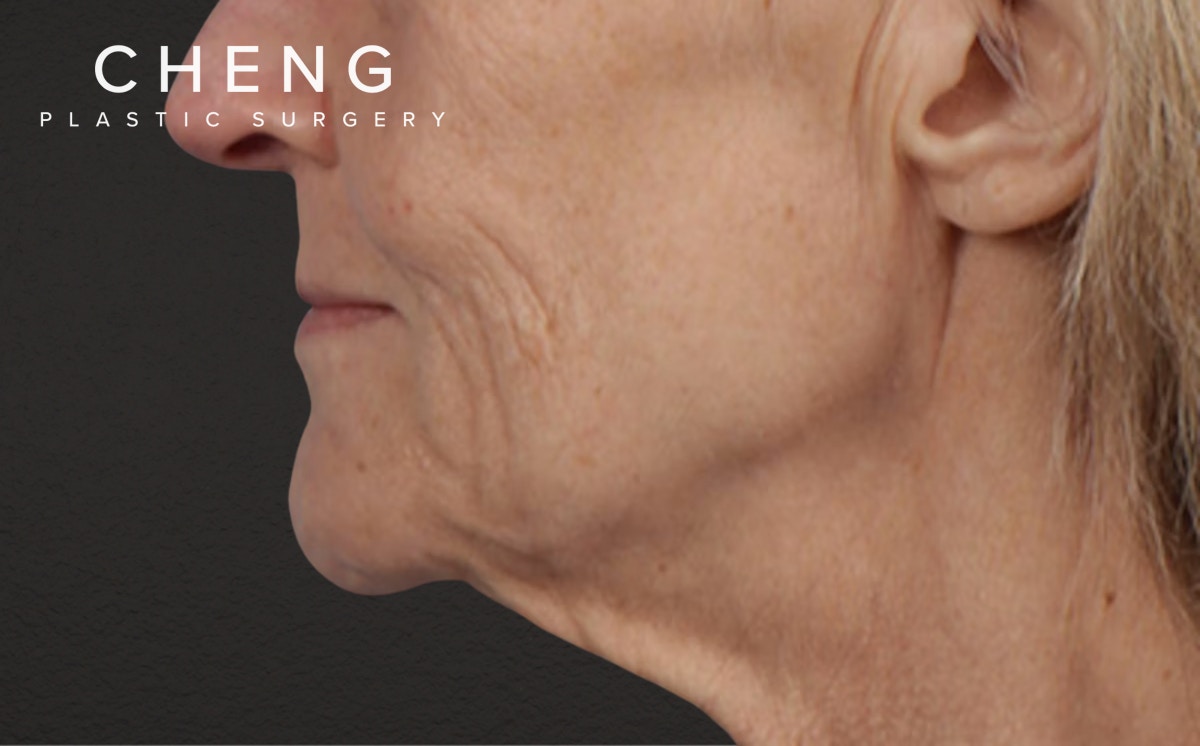 Lip Lift Before & After Gallery - Patient 340858 - Image 1