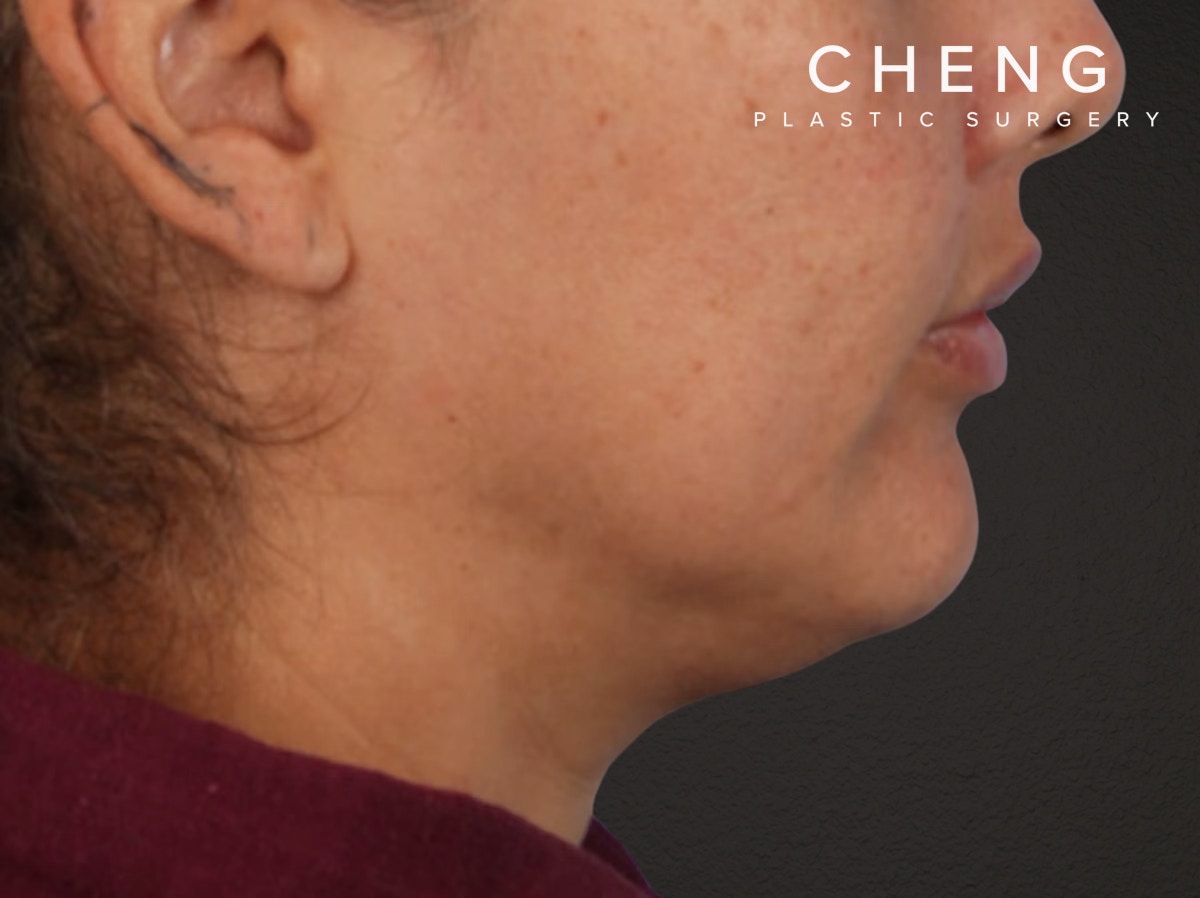 Lip Lift Before & After Gallery - Patient 191794 - Image 4
