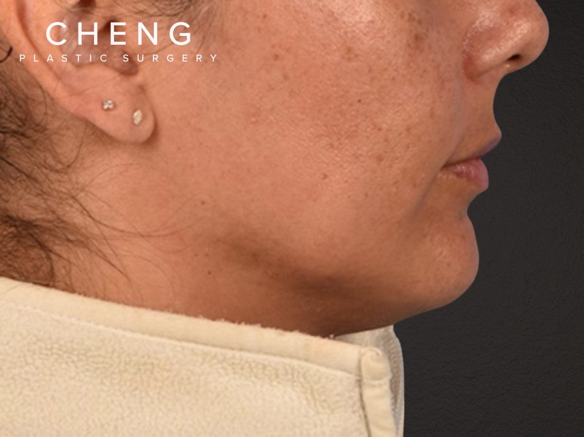 Lip Lift Before & After Gallery - Patient 191794 - Image 3
