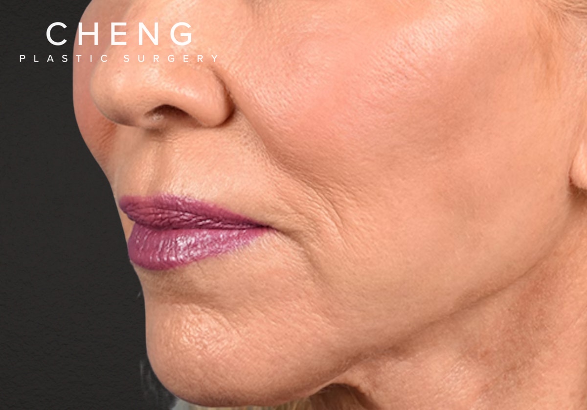 Lip Lift Before & After Gallery - Patient 698728 - Image 1