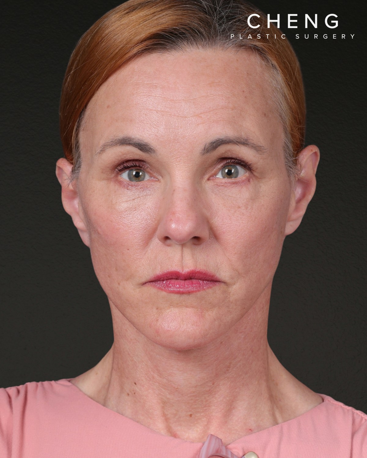 Facelift Before & After Gallery - Patient 298435 - Image 2