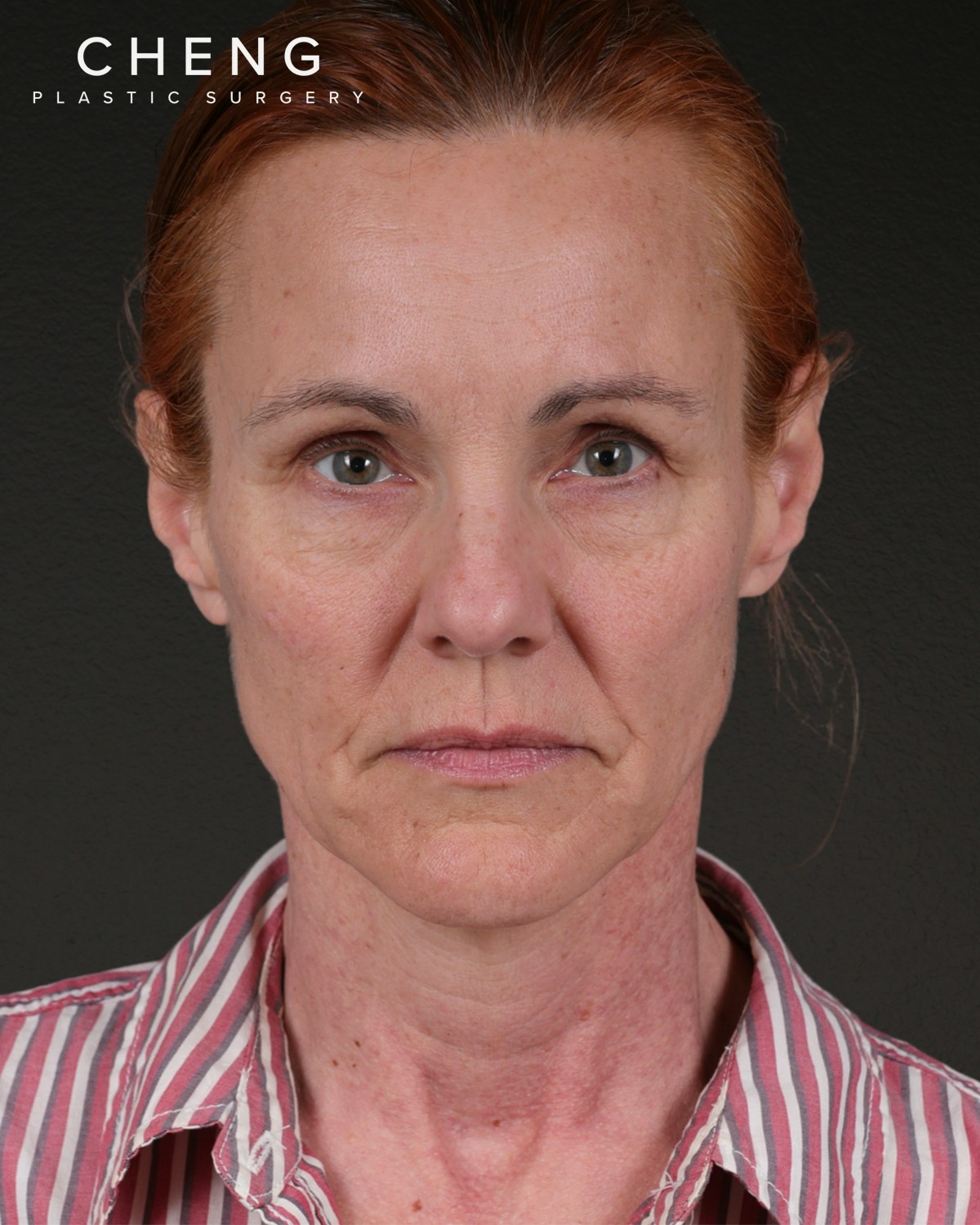 Facelift Before & After Gallery - Patient 298435 - Image 1