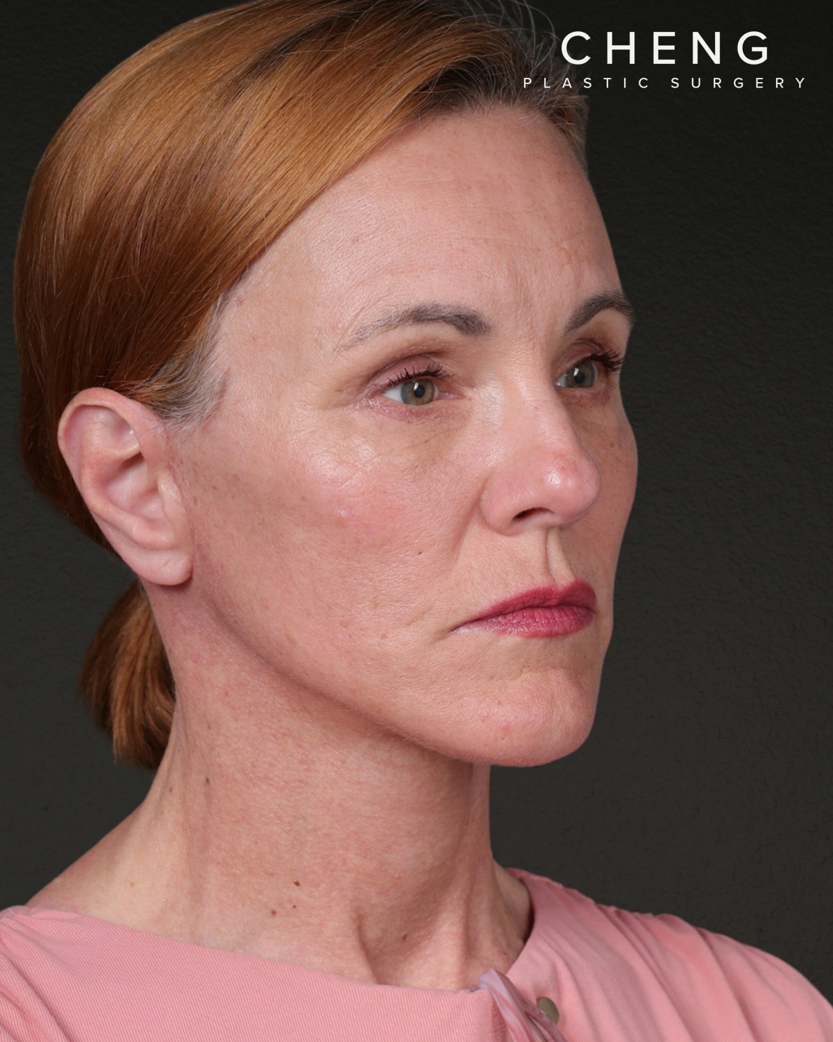 Facelift Before & After Gallery - Patient 298435 - Image 4