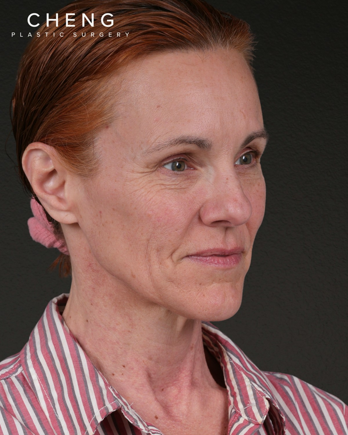 Facelift Before & After Gallery - Patient 298435 - Image 3