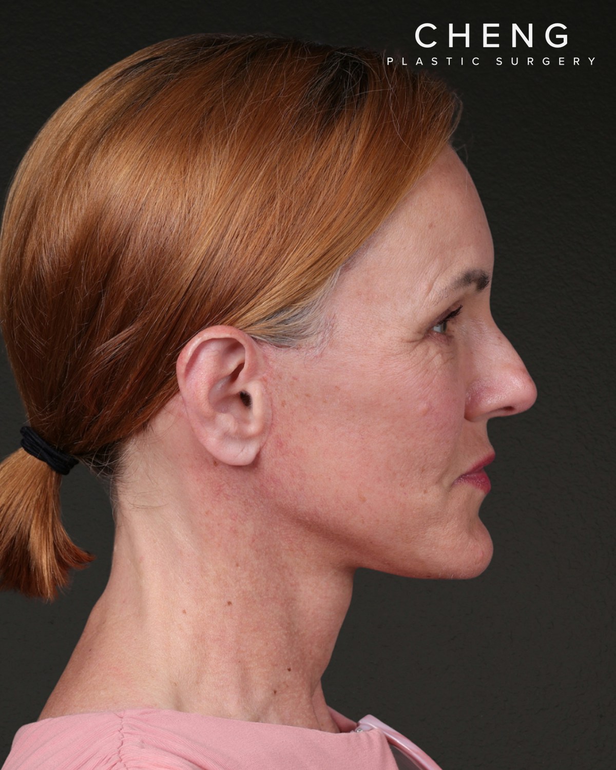 Facelift Before & After Gallery - Patient 298435 - Image 6