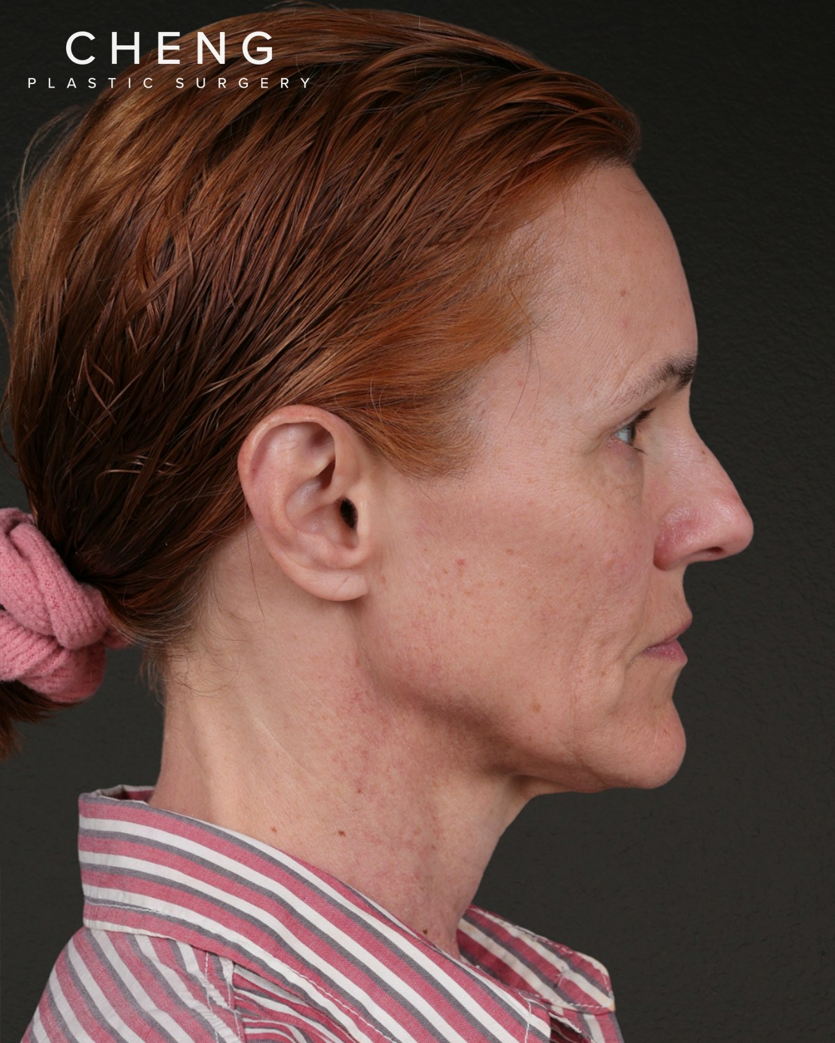 Facelift Before & After Gallery - Patient 298435 - Image 5
