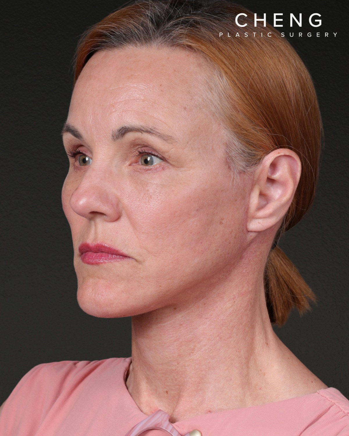 Facelift Before & After Gallery - Patient 298435 - Image 8