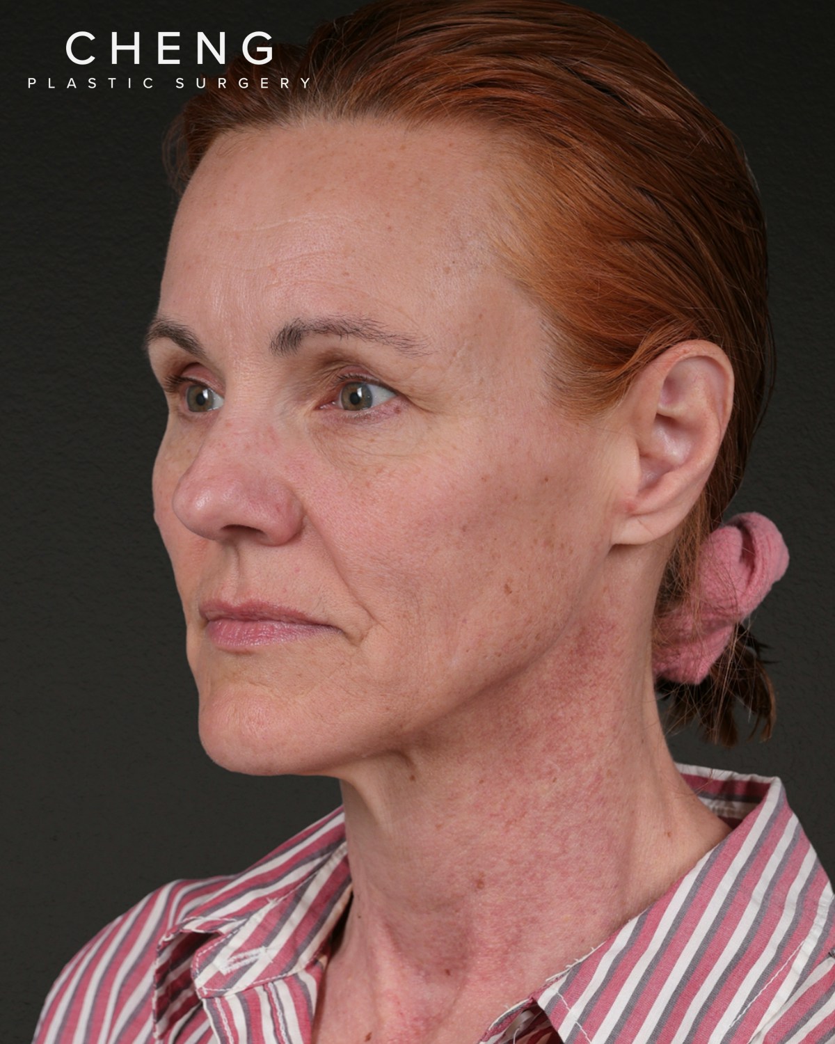 Facelift Before & After Gallery - Patient 298435 - Image 7