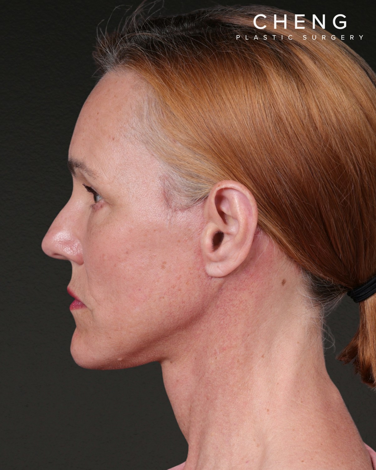 Facelift Before & After Gallery - Patient 298435 - Image 10