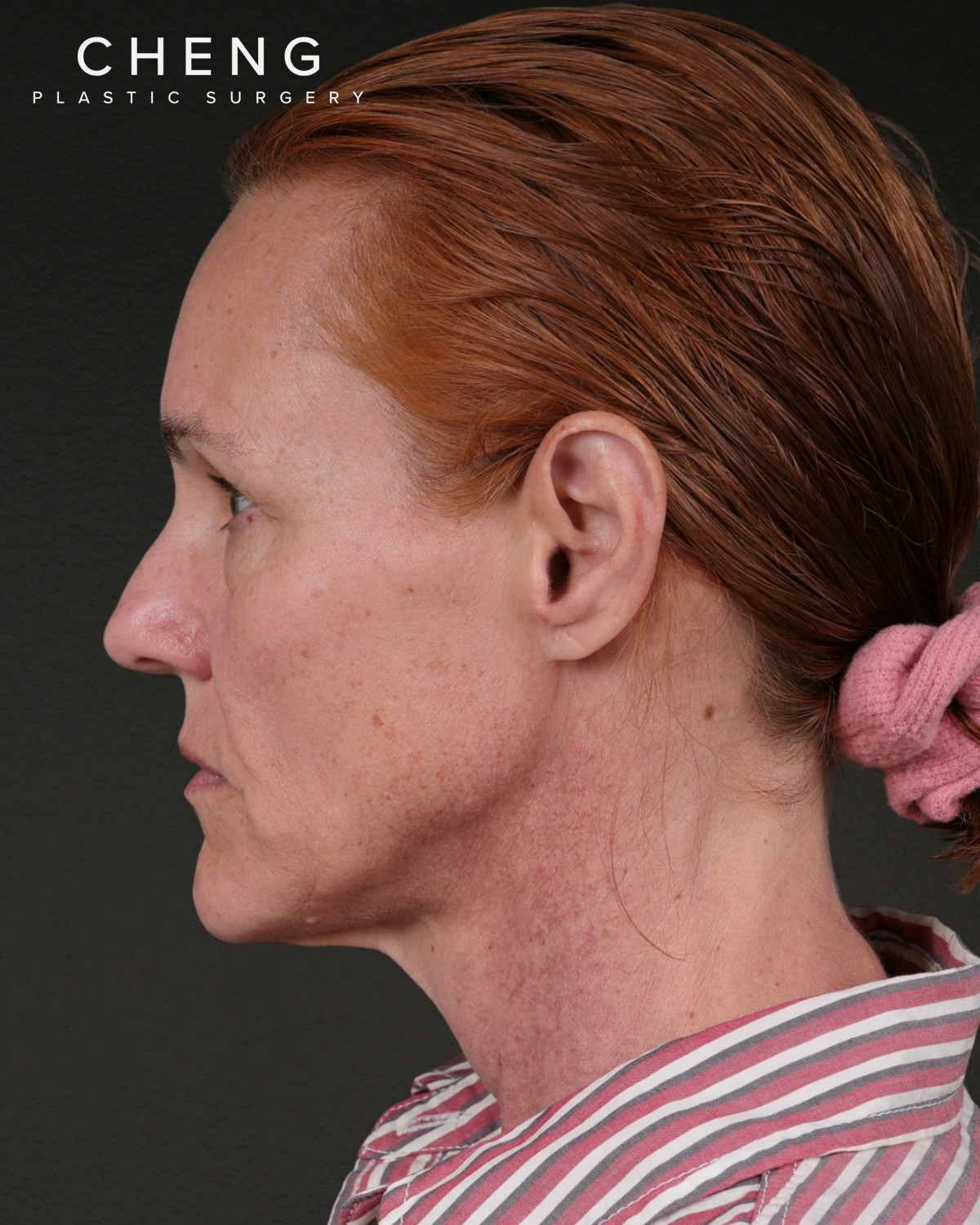 Facelift Before & After Gallery - Patient 298435 - Image 9