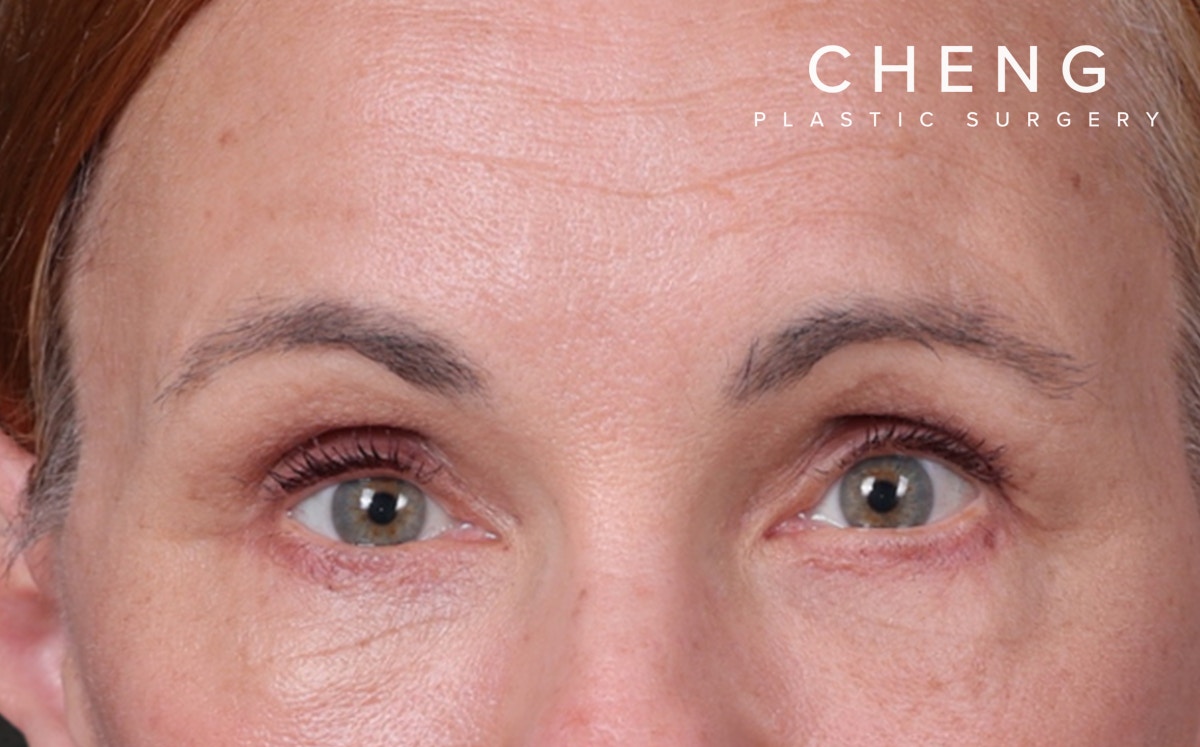 Blepharoplasty Before & After Gallery - Patient 117386 - Image 2
