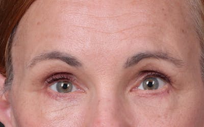 Brow Lift Before & After Gallery - Patient 363898 - Image 2